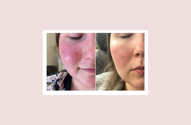 Rosacea behandeling voor en na